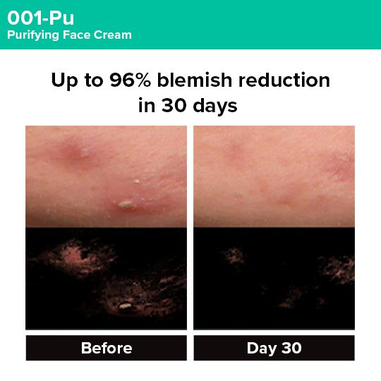 Photogrammetric image from clinical trial of 001-Pu Cream showing 94% blemish reduction in 30 days