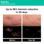 Photogrammetric image from clinical trial of 001-Pu Cream showing 94% blemish reduction in 30 days