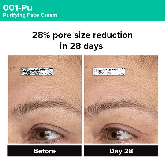 Photogrammetric image from clinical trial of 001-Pu Cream showing 28% pore size reduction in 28 days