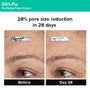 Photogrammetric image from clinical trial of 001-Pu Cream showing 28% pore reduction in 28 days