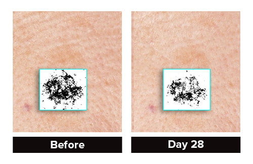 Photogrammetric image from clinica rila of 004-Br Skin Brightening Cream showing 44% reduction in age spots
